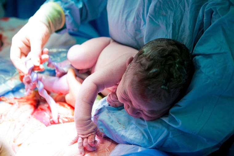 ניתוח קיסרי