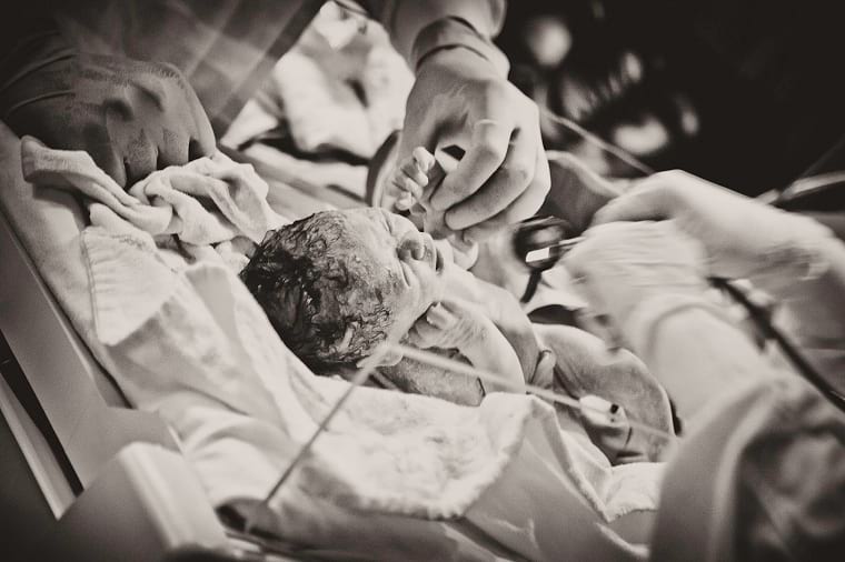 שיתוק מוחין מלידה